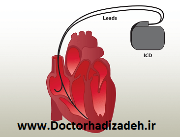 ICD قلب